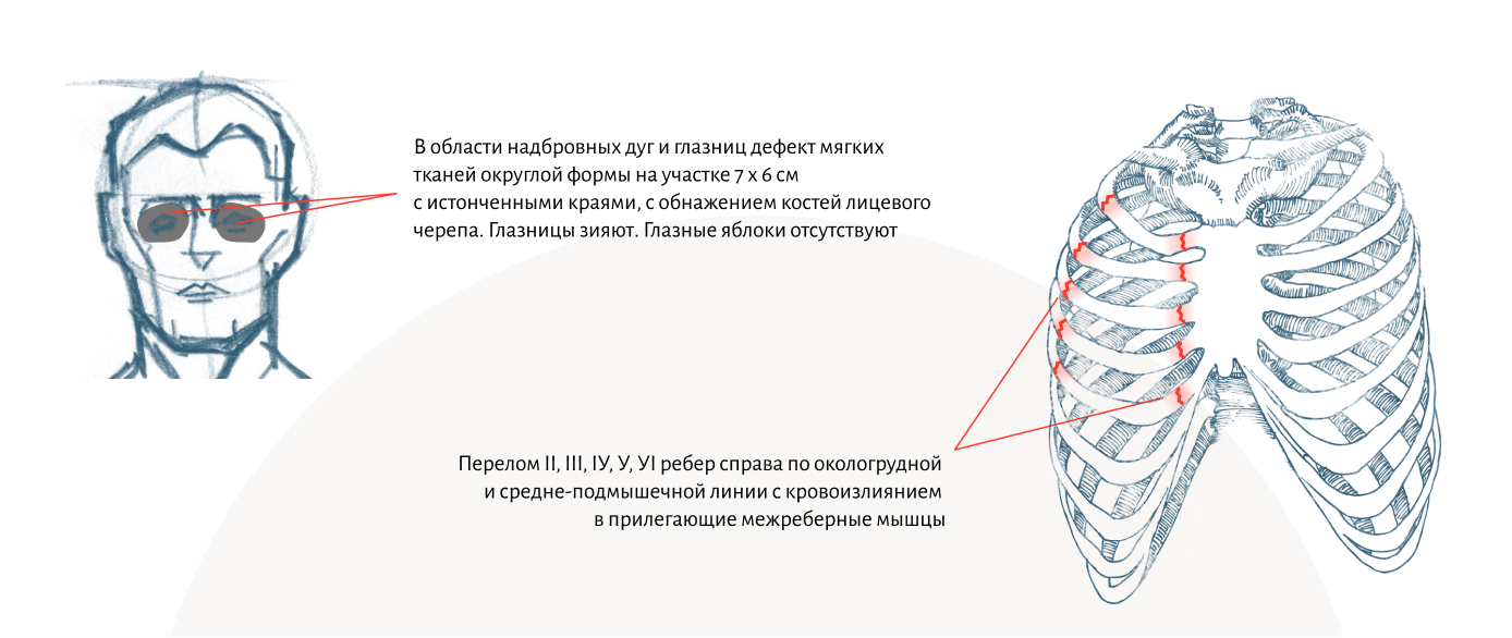 Закрытый перелом ребра карта вызова