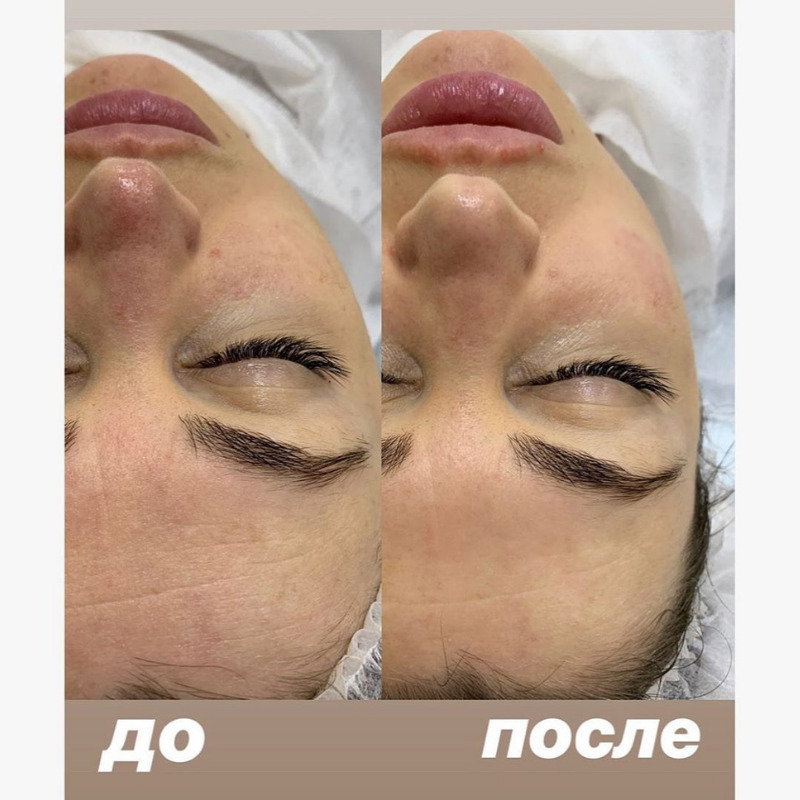Миндальный пилинг лица: фото до и после, отзывы специалистов, как ...