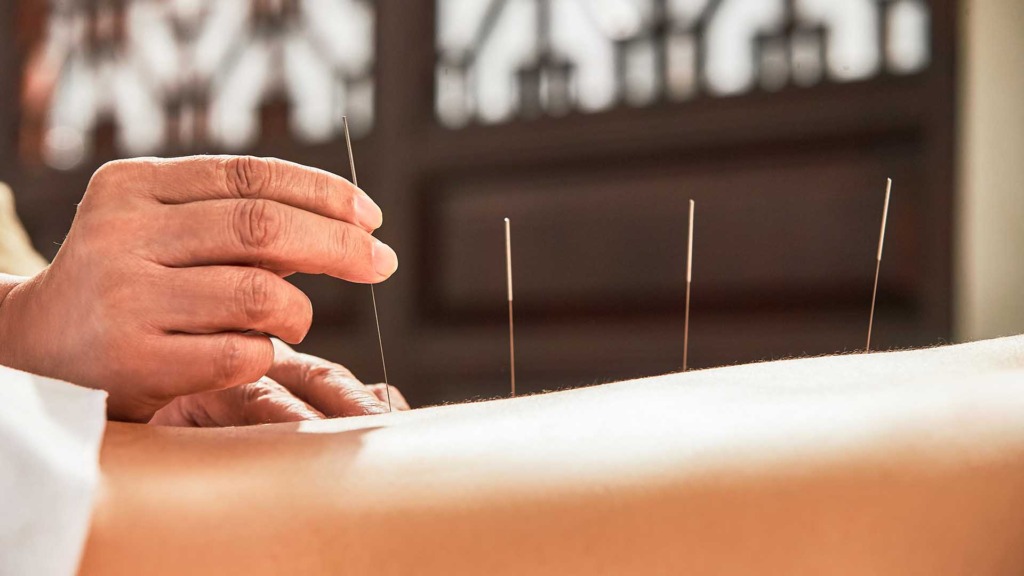 Иглоукалывание